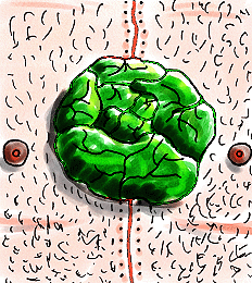 Drawing of a bright green cabbage-like heart sitting on a hairy, pale chest between two nipples, a dotted red incision line running down the middle
